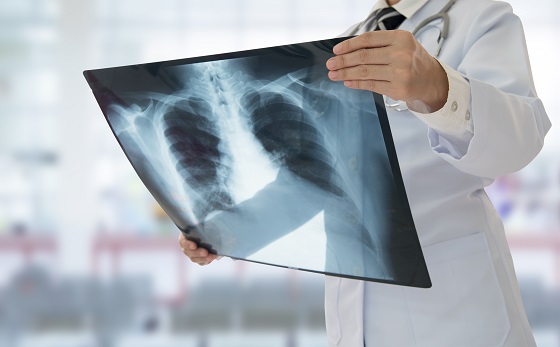 tuberculoza